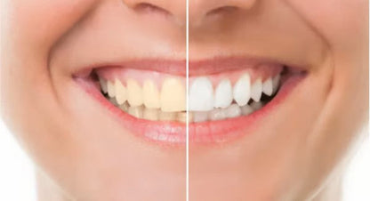 SmilePure Pro™ | Votre sourire blanc commence ici | 1+2 gratuits